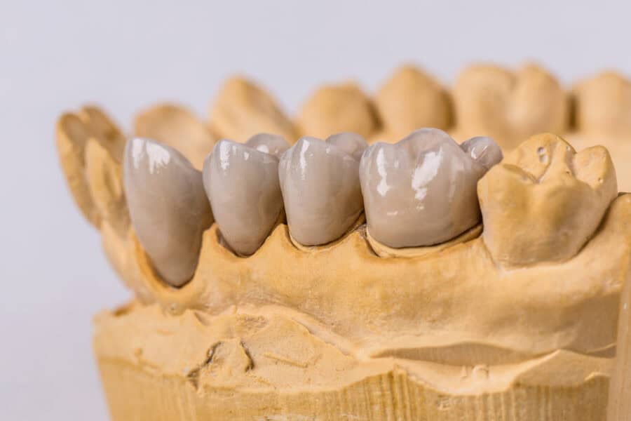dental implants in Preston