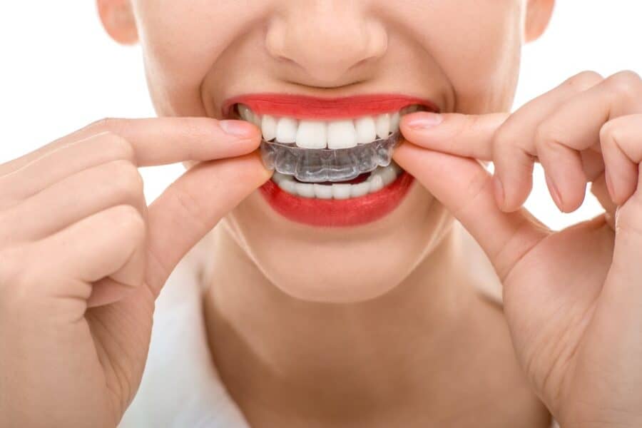 Invisalign Preston