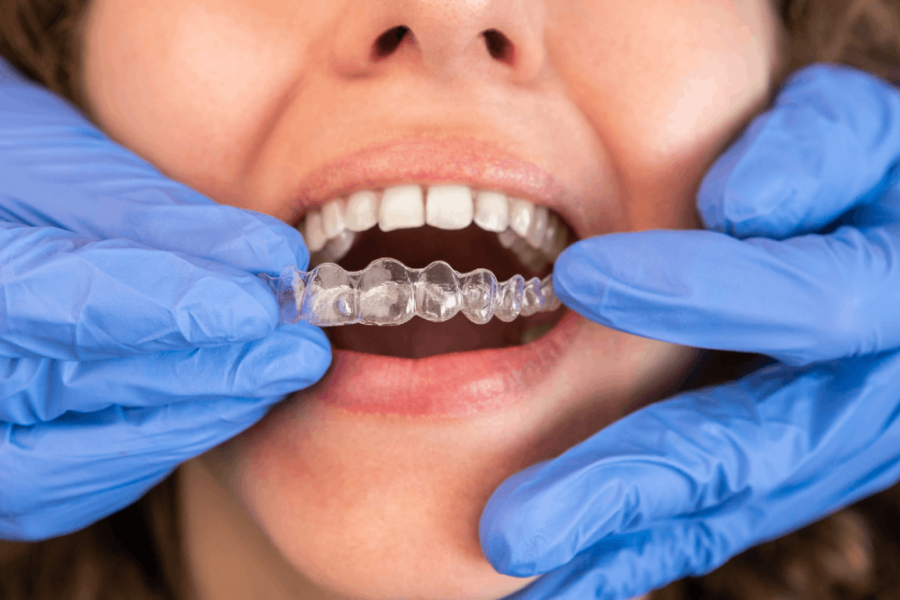 Will Invisalign® wear my tooth enamel